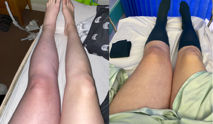 Lia’s account of a medical procedure that lead to the her developing serious blood clots and a diagnosis of Factor 5 Leiden