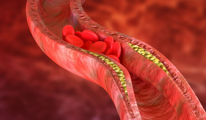 Rivaroxaban Appears Safe, Effective for Pediatric Acute Venous Thromboembolism